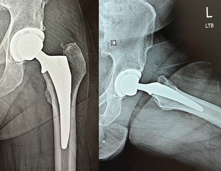 DePuy Actis Stem & Pinnacle Socket Total Hip Prosthesis (Implant 240129)